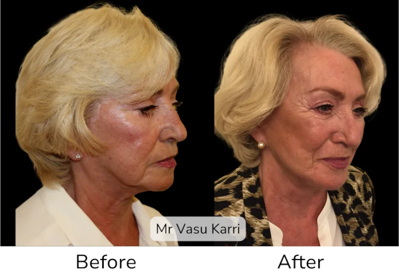 Facelift Patient 19 View 1